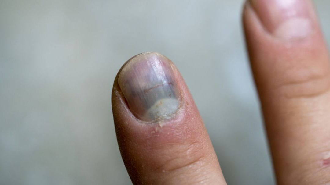 Pourquoi mon ongle est-il marron ? Causes et traitements